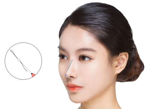 Nose-Threadlift